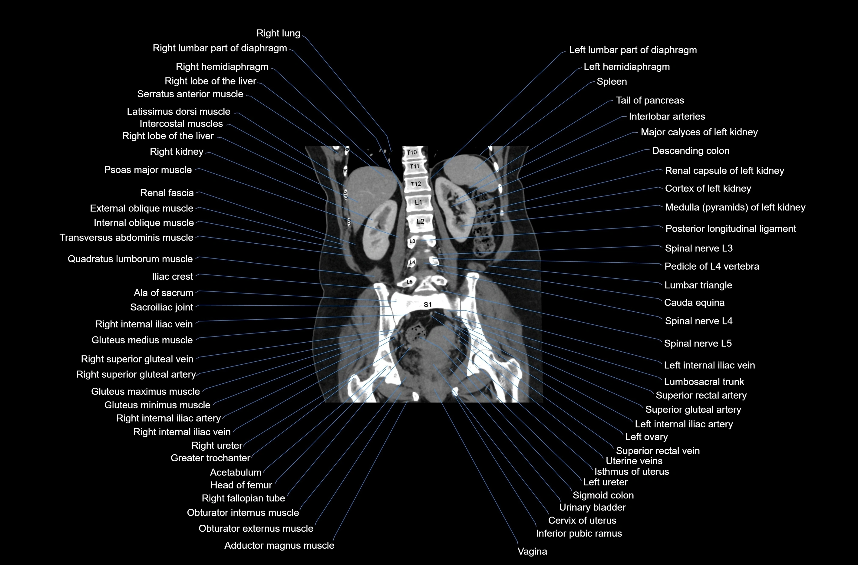 CT abdomen coronal cross sectional anatomy labelled radiology image-00059.webp